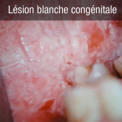 lésion blanche congénitale