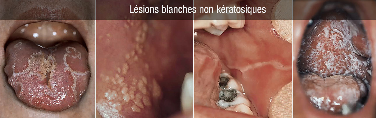 lésions blanches non kératosiques