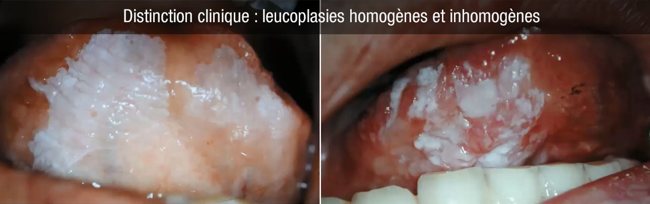 leucoplasies homogèes inhomogènes