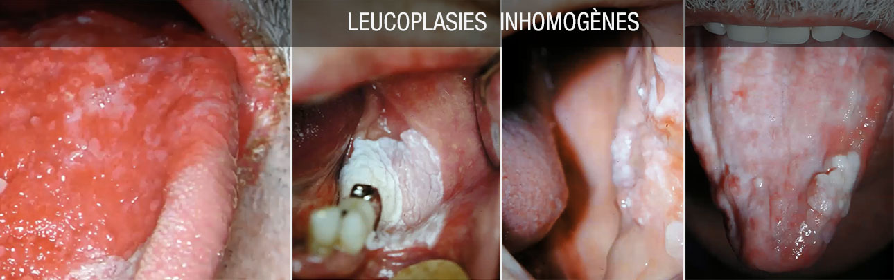 leucoplasies inhomogènes