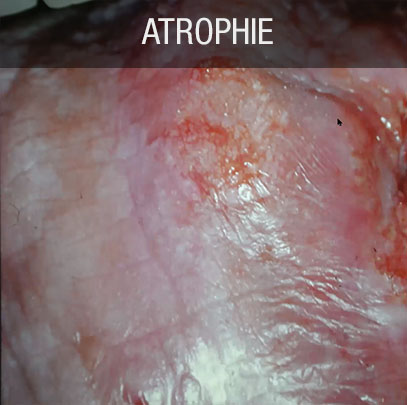 Lichen plan buccal atrophie