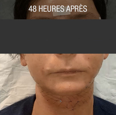 lifting 48 h après