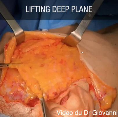 Lifting Deep Plane