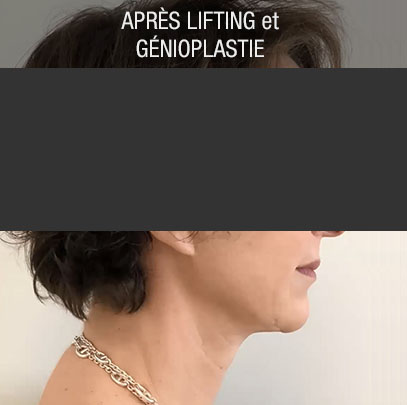 lifting et génioplastie