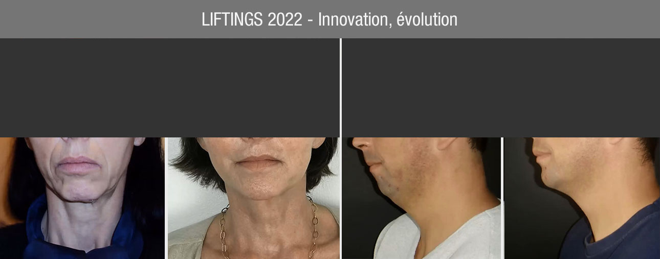 liftings, médecine et chirurgie esthétique liftings évolution et innovation