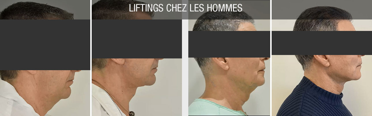 liftings hommes