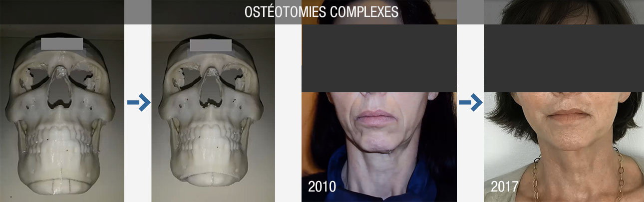 ostéotomies complexes