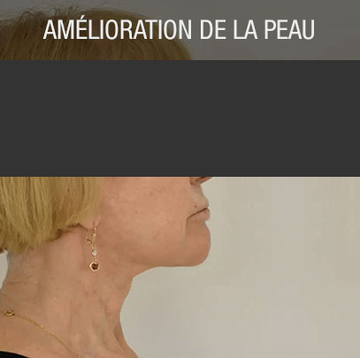 amélioration de la peau médecine régénérative