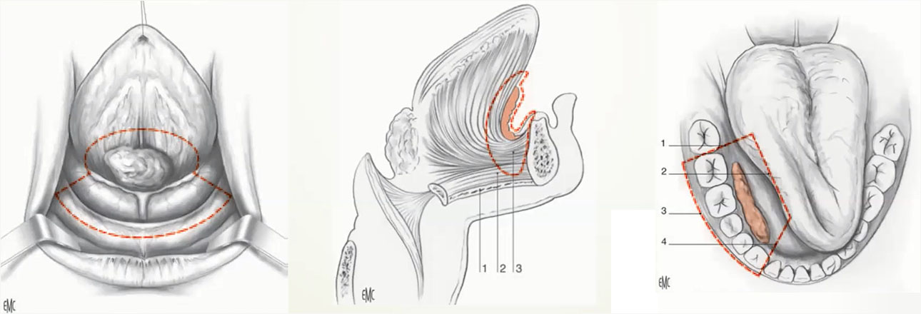 pelvectomies