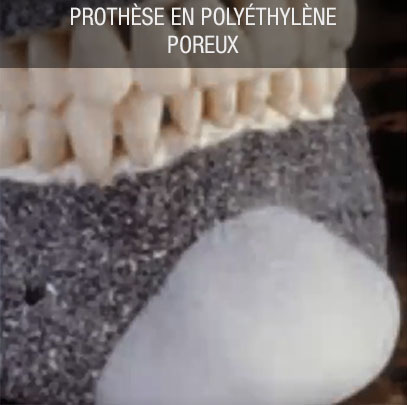 prothese polyethylene poreux
