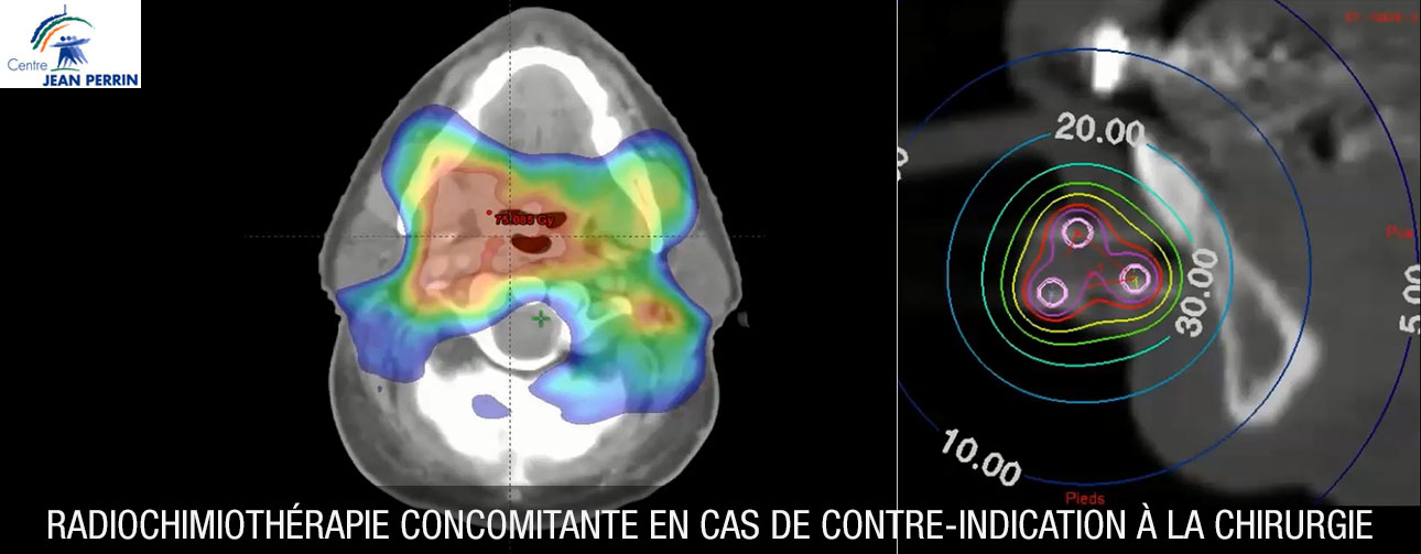 Radiochimiothérapie concomitante