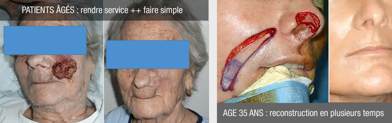 reconstructions difficiles retouches visage,age