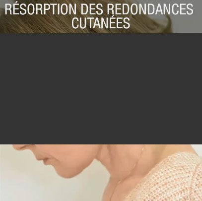 résorption des redondances cutanées