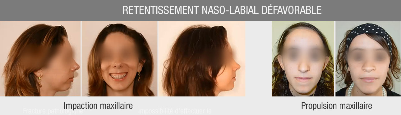 retentissement nasolabial chirurgie orthognathique