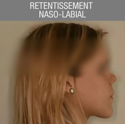 retentissement naso-labial chirurgie orhognathique