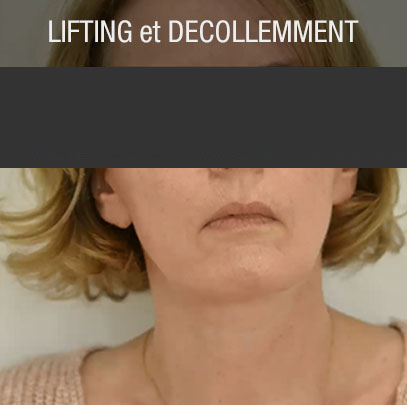 rides lifting décollement