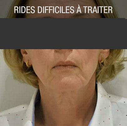 rides difficiles à traiter