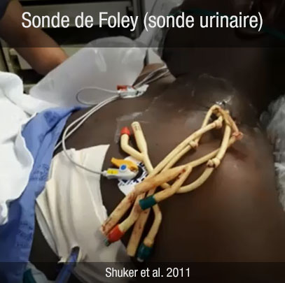 sonde de Foley