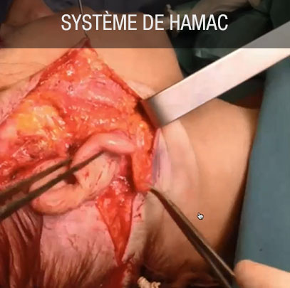 chirurgie esthétique, système de hamac d'une oreille à l'autre qui passe sous le menton tension sous le menton