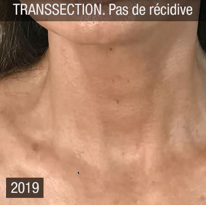 chirurgie esthétique, transsection après relâchement des muscles malgré lifting transsection chirurgie esthétique