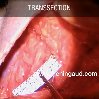 Transsection suite à lifting raté