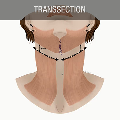 transsection