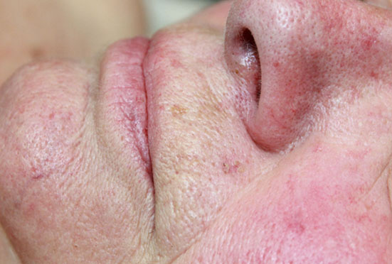 Carcinome basocellulaire de la lèvre supérieure blanche
