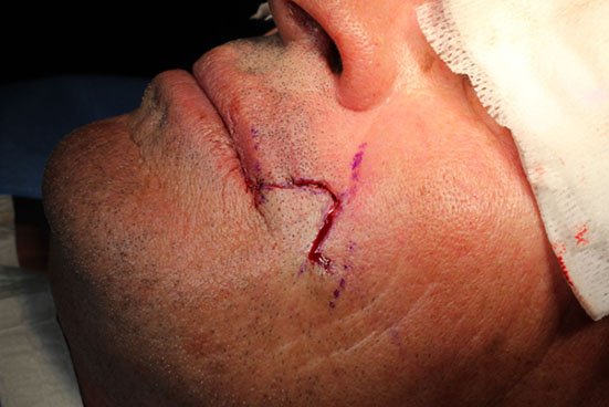Résection du triangle cutanéo-muqueux décollement suture