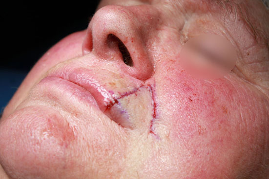 Suture sous cutanée au Monocryl 4.0, suture de la lèvre rouge au Vicryl 4.0