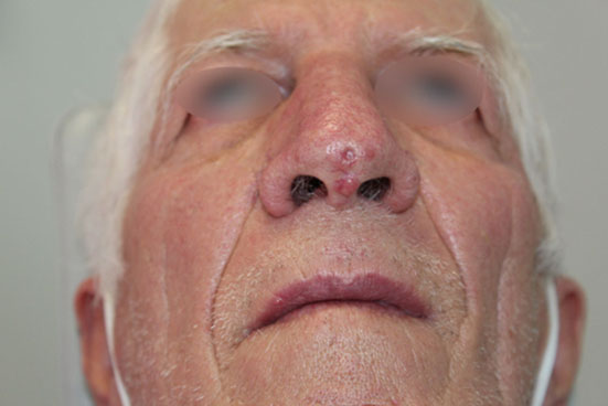 Carcinome basocellulaire de la pointe du nez et de la columelle