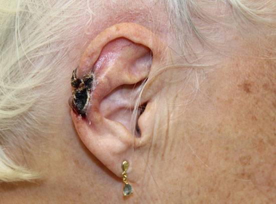Carcinome basocellulaire infiltrant de l'hélix