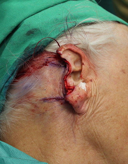 Exérèse transfixiante de la pièce opératoire, incision du lambeau