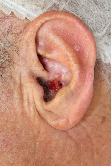 Carcinome basocellulaire de la conque de l’oreille