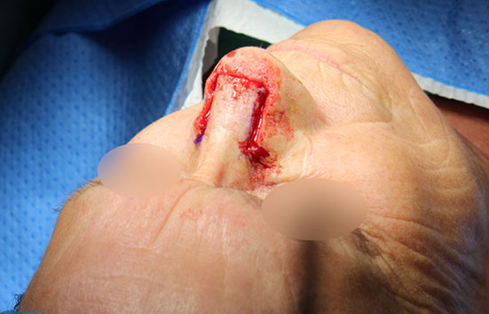 Mise en place du lambeau suture sous-cutanée