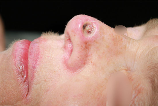 Carcinome épidermoïde de la pointe du nez