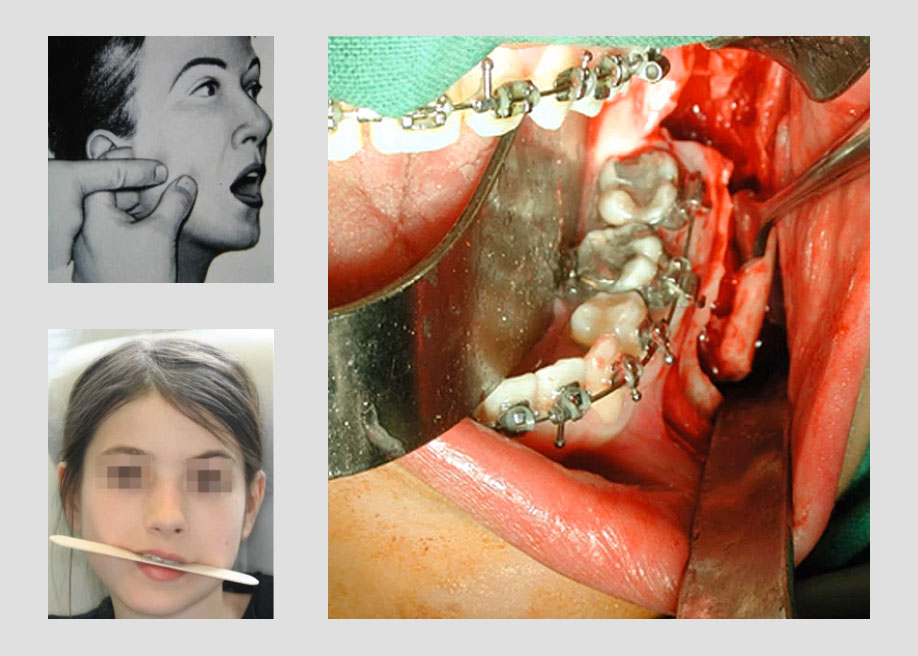 Chirurgie orthognathique et SADAM