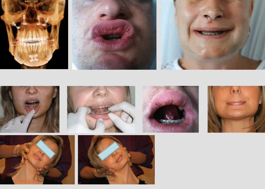 reeducation precoce chirurgie orthognatique