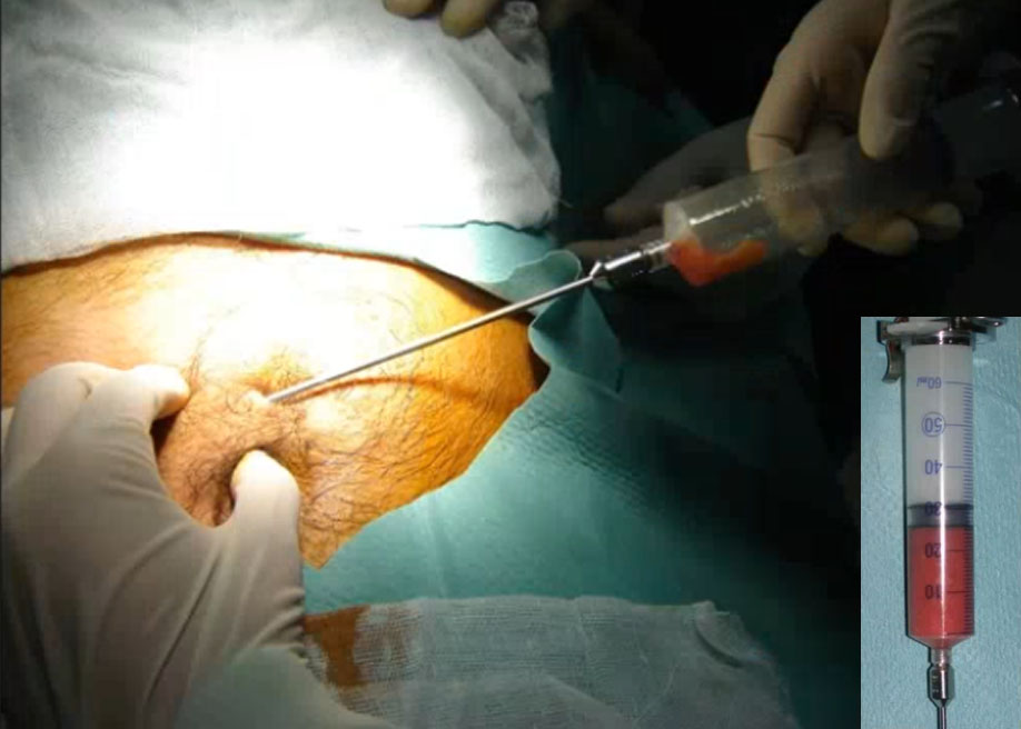 lipofilling
