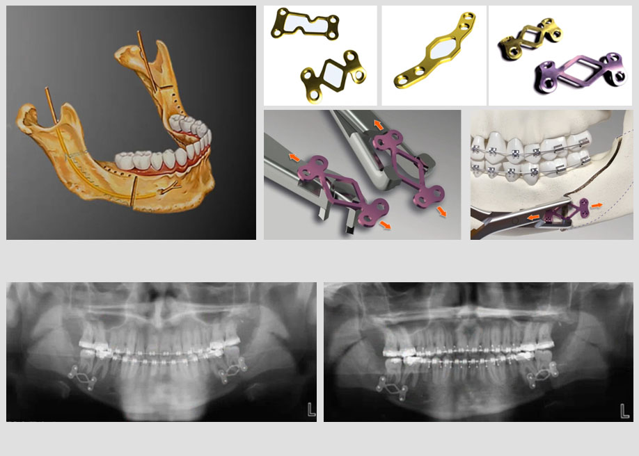 Plaques à réglage sur site, ostéotomies sagittales mandibulaires