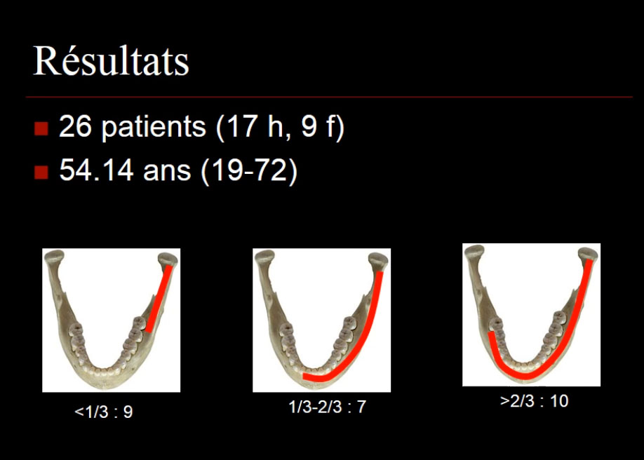 prothèse sur implant Lambeau de fibula microanastomosé