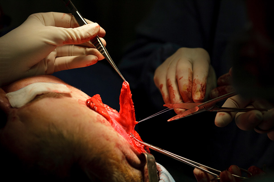 lambeau chirurgie maxillo faciale