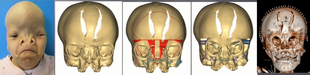 chirurgie orbitaire cad cam