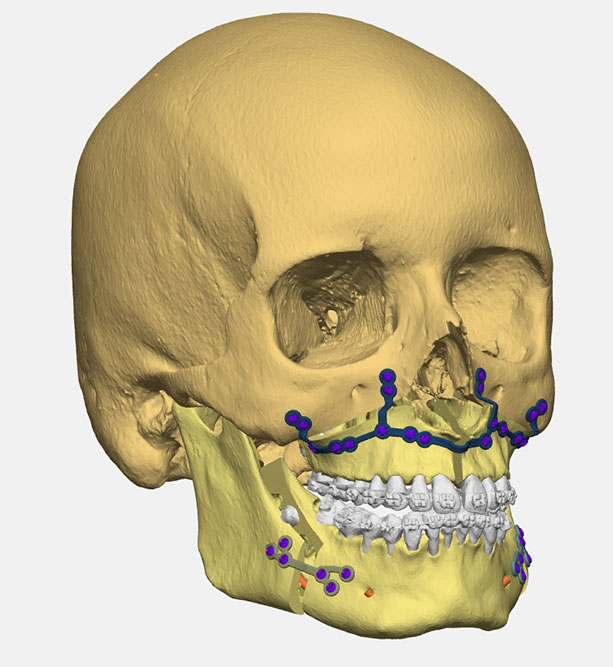 Chirurgie orthognathique mâchoire