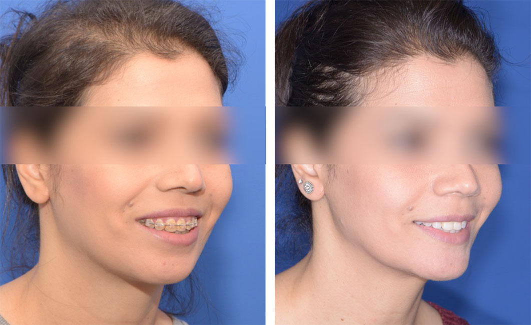 chirurgie orthognathique orthopédie dento maxillo faciale