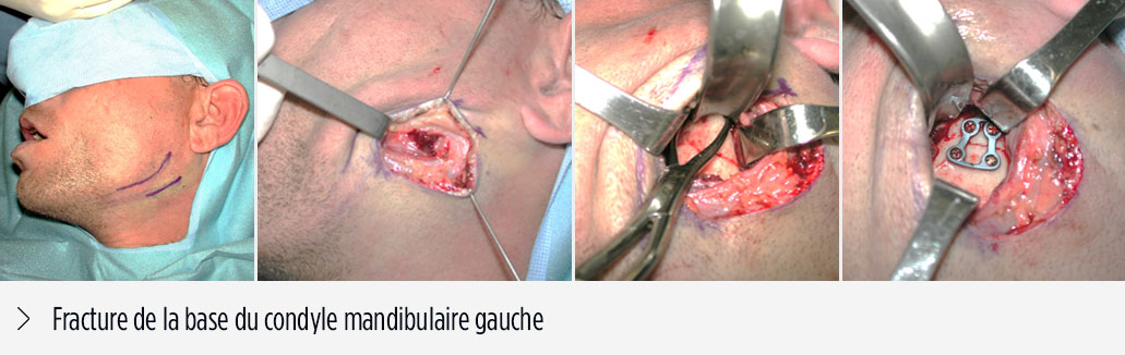 Fracture base du condyle mandibulaire gauche