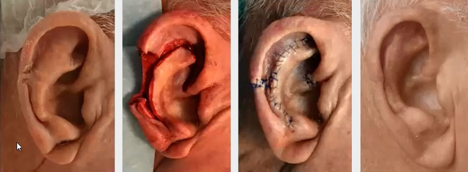 Reconstruction des pertes de substance de l'oreille