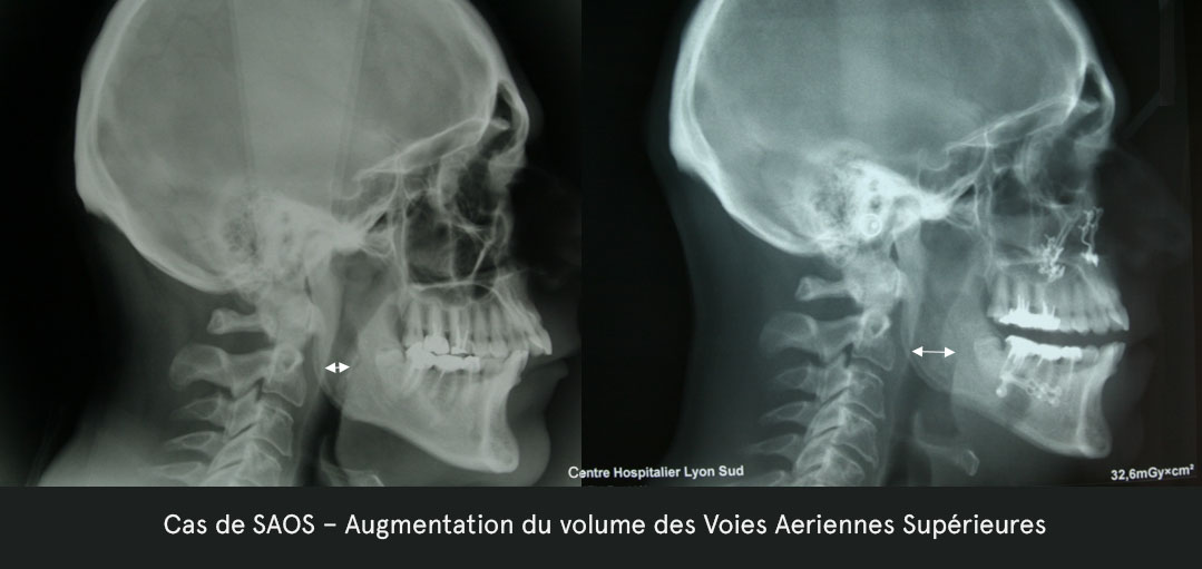 saos dysmorphies maxillomandibulaires