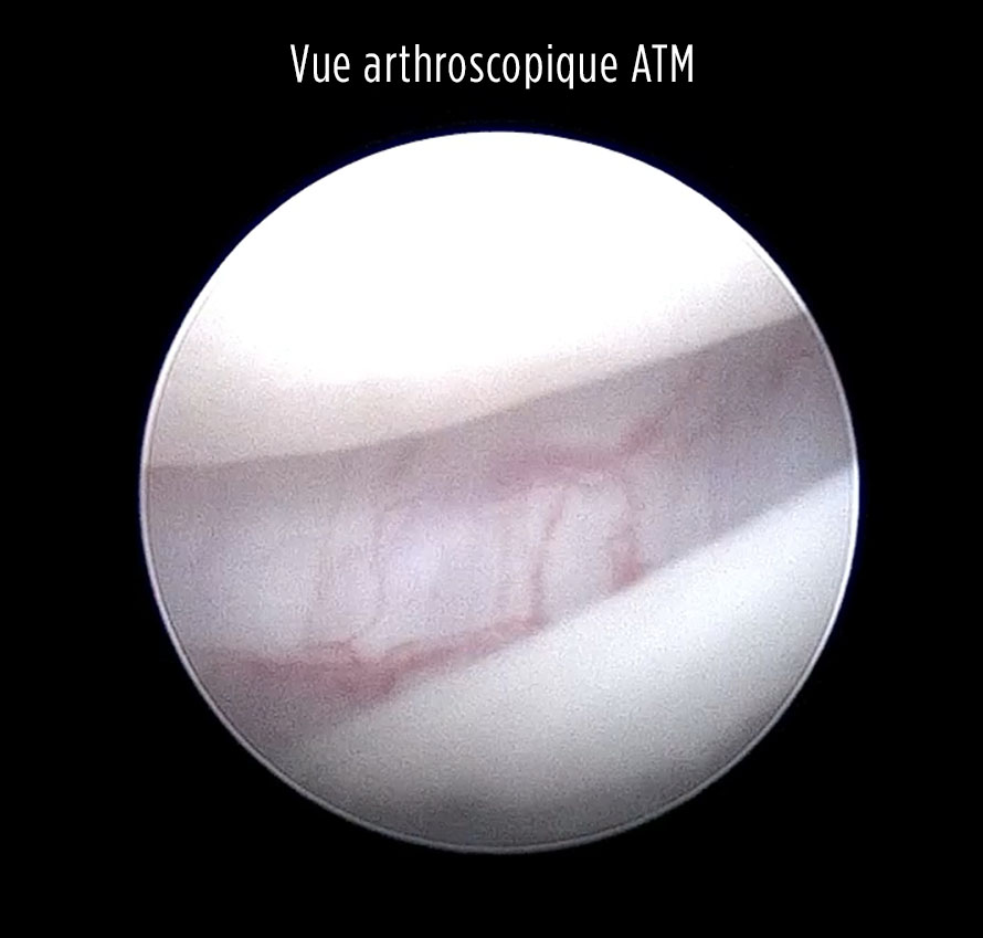 vue arthroscopique ATM