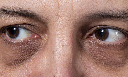 cernes sous les yeux
