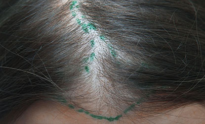 greffe de cheveux femme